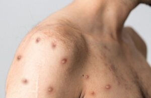 Primeiro caso de varíola dos macacos no Líbano é confirmado